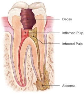 Root Canal Tooth