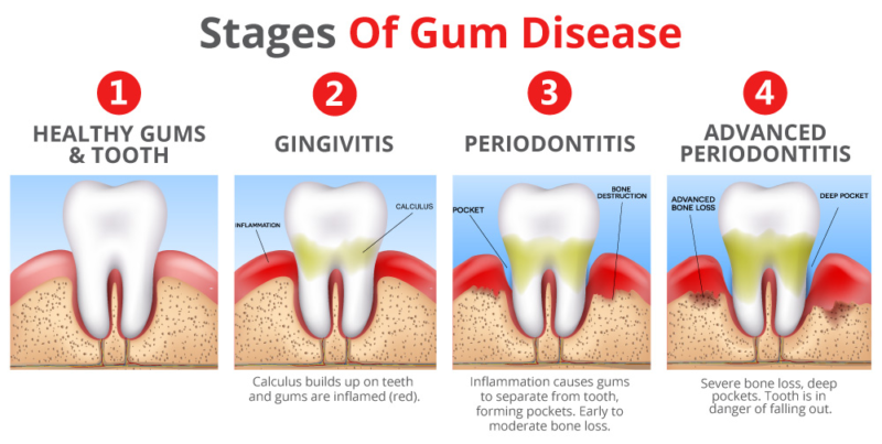 Periodontitis Its Causes Warning Signs And How To Prevent It Dr
