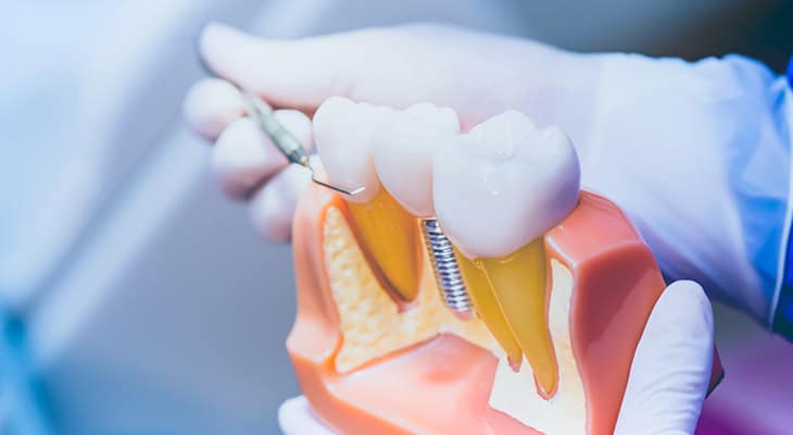Cheap Dental Implants: You Get What You Pay For