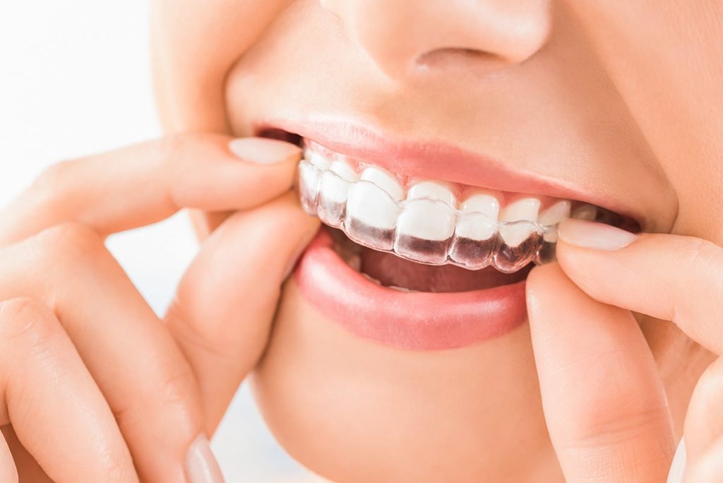 Do It Yourself Orthodontics: Save Money or Make Your Problem Worse?